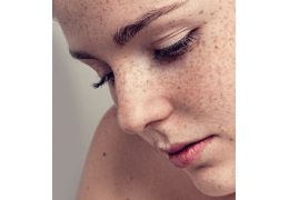 Melasma - ako ju odstrániť v salóne?